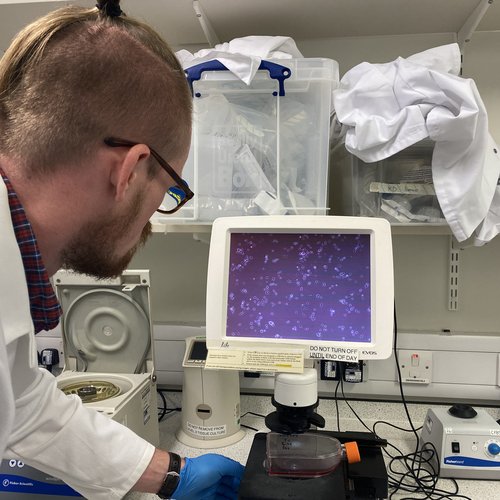 A scientist in a lab coat looks at a monitor showing magnified neuroblastoma cells, surrounded by lab equipment.